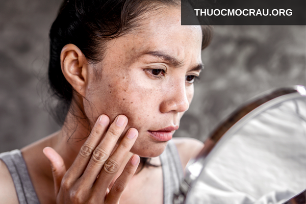 Hiểu đúng về tình trạng “nám nặng”