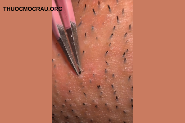 Vì sao nhổ râu lại gây đau?