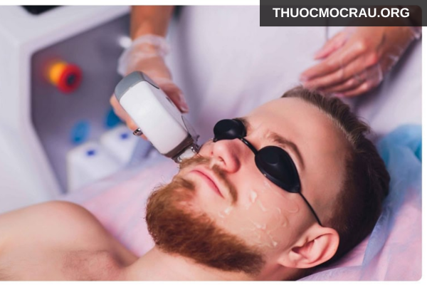 Triệt lông công nghệ cao