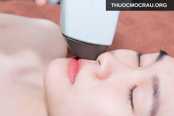 Cách xử lý ria mép không bị thâm da