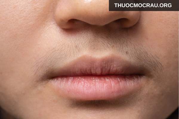 Ria mép ở nữ hình thành do đâu?