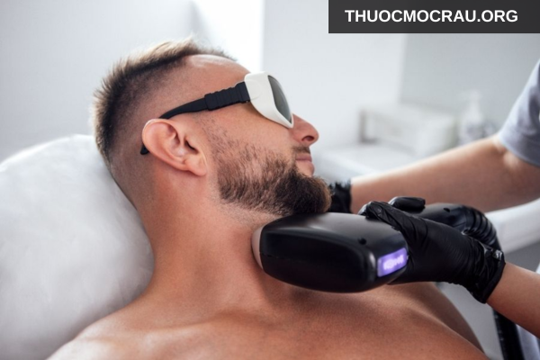 Triệt lông bằng công nghệ (laser)