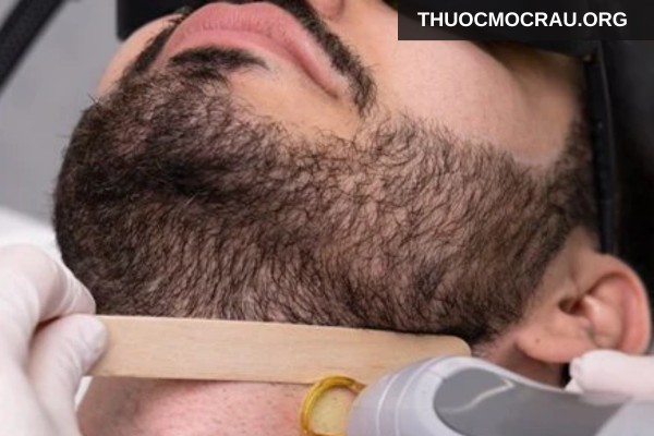Triệt râu bằng laser