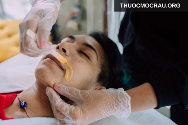 Triệt râu có vĩnh viễn không?