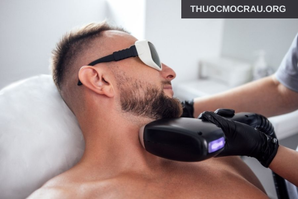Triệt râu bằng công nghệ hiện đại