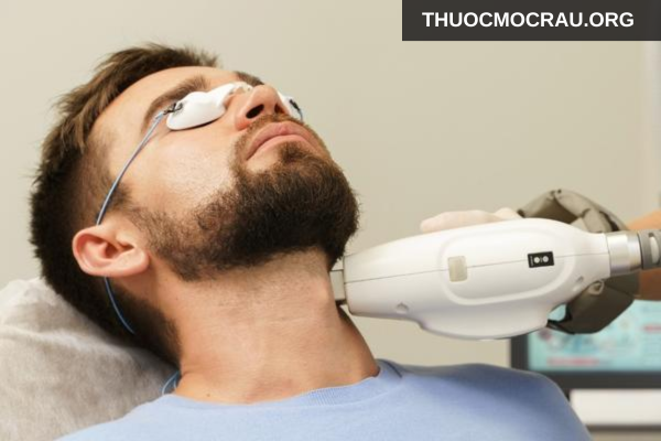 Triệt râu bằng laser giúp giảm mọc lâu dài