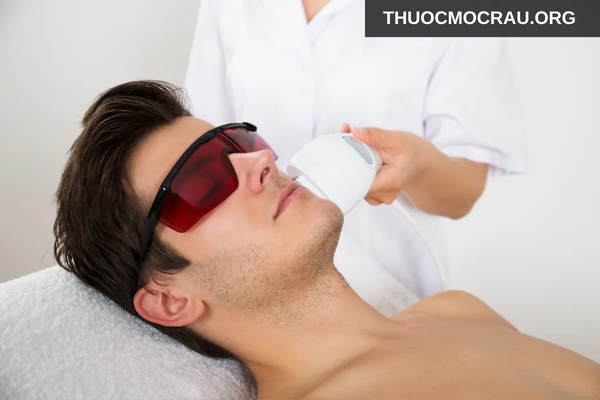 Triệt râu bằng laser nếu muốn giảm râu lâu dài