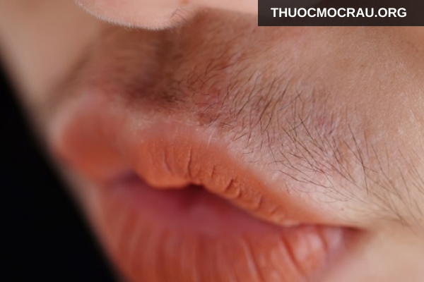 Mất cân bằng nội tiết tố