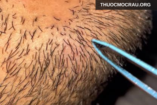 Nhổ râu có làm râu mọc nhiều hơn không?