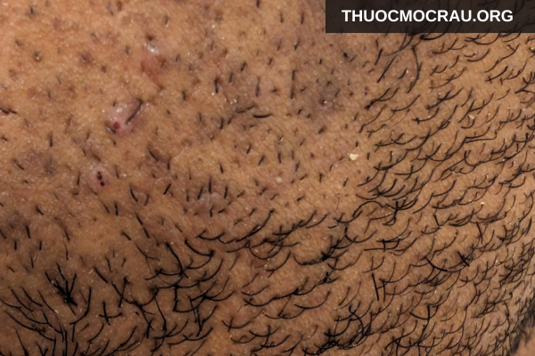 Nhổ râu có thể gây râu mọc ngược