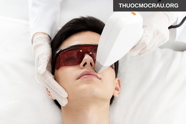 Triệt ria mép bằng laser có mọc lại không?